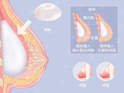 五、广东韩妃整形外科医院假体隆胸真实实例分享