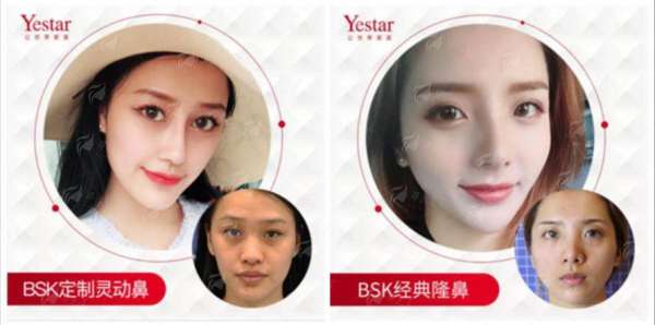 三、深圳艺星张安利和朱辉双眼皮手术的价格对比