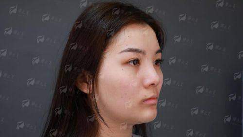 二、洛阳莱尔美整形医院做隆鼻要多少钱？价格攻略来了