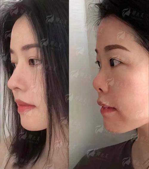 三、在洛阳莱尔美整形医院预约隆鼻的3个正确姿势