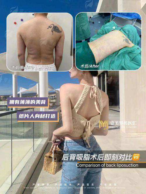 三、欣姿美超微乳化祛富贵包价格贵吗？