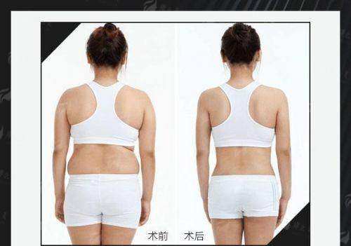 四、欣姿美超微乳化祛富贵包怎么预约？