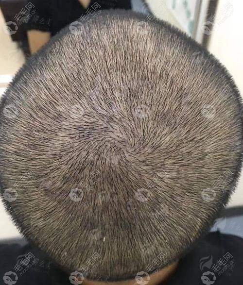 发际线种植哪家强？贵州黔南菲梵医美真实口碑+医生特色技术大揭秘