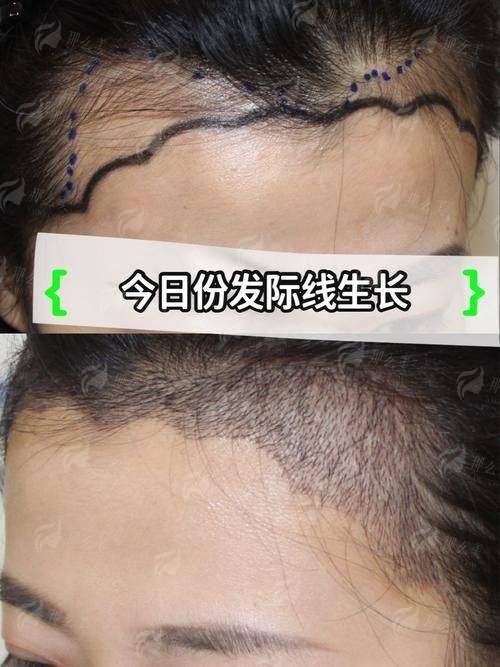 二、贵州黔南菲梵医美发际线种植的医生技术强在哪?