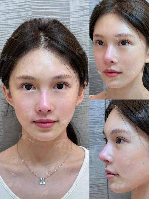 四、怎么预约王艳医生的鼻修复手术？