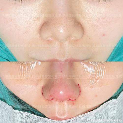 二、上海伯思立做鼻修复有哪些优势？