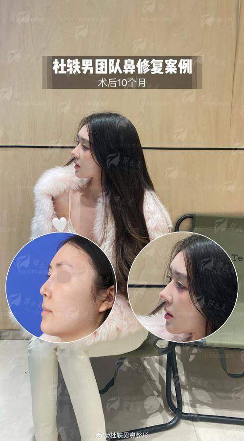 鼻修复找王艳医生靠谱吗？上海伯思立真实案例+价格分析，术后效果全公开