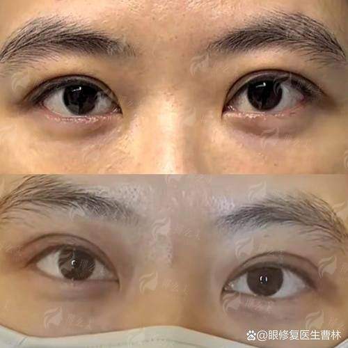 三、隆胸手术谁更自然？五洲医院的三大技术优势