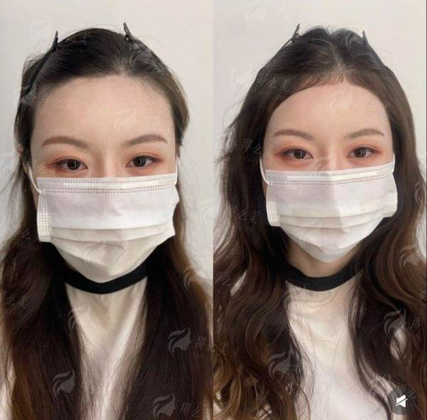 四、贵州黔南菲梵医美发际线种植怎么预约?这些细节要注意!