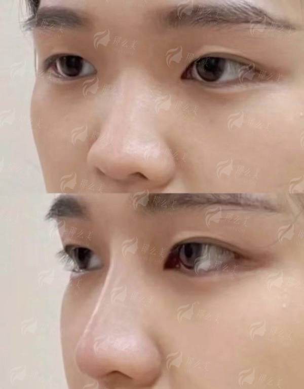 想找刘战辉做隆鼻？洛阳莱尔美整形医院预约方式+术后护理指南