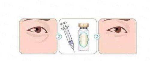 <strong>二、北京薇琳医疗美容医院史浩北拉皮手术的技术亮点</strong>