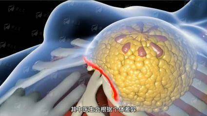 四、北京薇琳特木尔巴隆胸真实实例分享