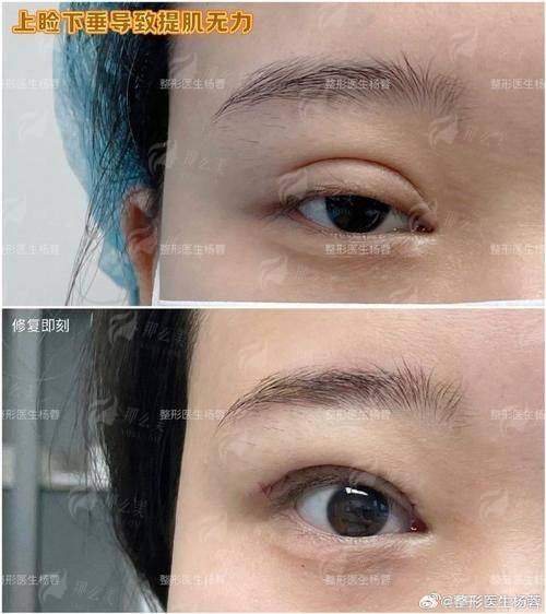 想知道上海艺星医疗美容医院（长宁院）许炎龙和王肖琴谁做双眼皮更自然？对比结果大揭秘！预约方式大公开