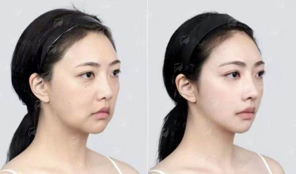 北京薇琳杨芩瑜拉皮技术亮点全解析，术前评估及预约挂号方式公布！