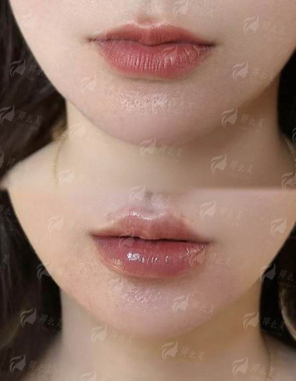 北京薇琳邓立育和崔庆涛双眼皮谁最自然？价格分析+医院介绍，坐诊地址和预约方法