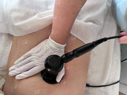 冯牧夷医生吸脂技术怎么样？重庆铜雀台整形医院吸脂案例+价格分析，在线预约！