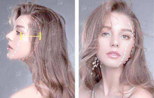 三、五代vs四代热玛吉怎么选？北京美丽之冠价格指南