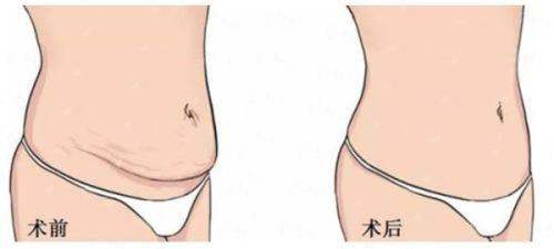 四、合肥韩宫整形腰腹吸脂如何预约？