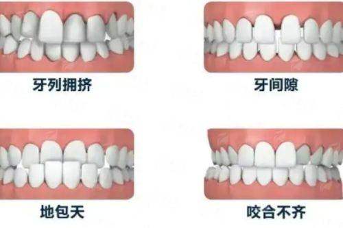 二、广西横州牙博士口腔隐形矫正成效如何？