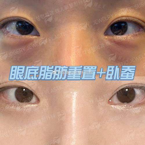 <strong>三、裴宰莹医生眼底脂肪重置的技术特色</strong>