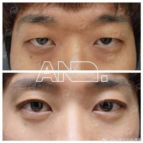 <strong>五、术后护理及注意事项</strong>