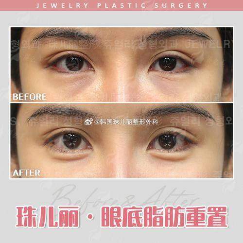 <strong>二、眼底脂肪重置的原理与优势</strong>