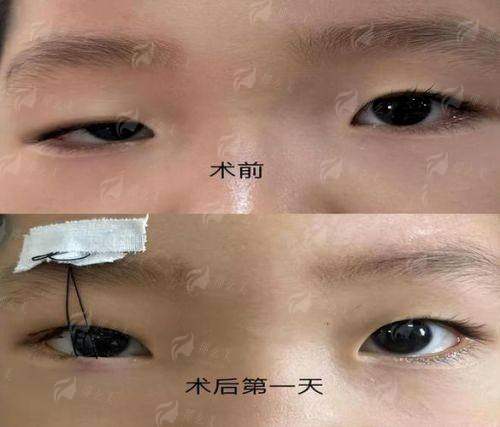 惊！上海艺星医疗美容医院（长宁院）彭才学上睑下垂矫正效果竟这么好，附价格了解！