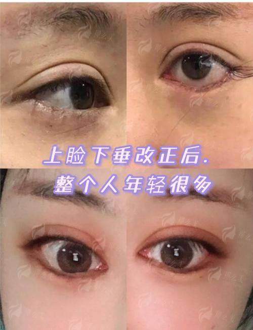 二、上睑下垂矫正手术方案设计