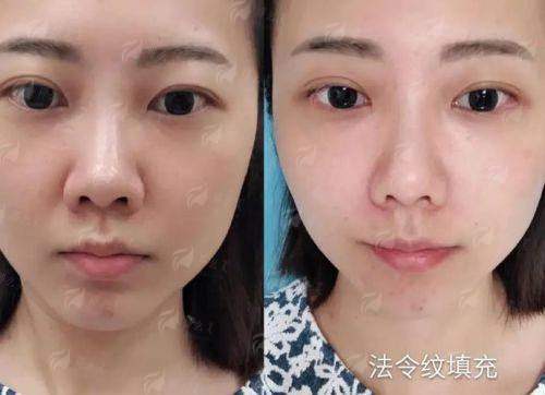 一、柳州华美胡晓波脂肪填充凭什么火？自然派填脂天花板！