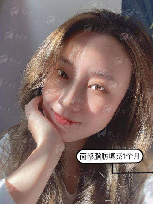 二、柳州华美胡晓波脂肪填充2026价目表！全脸/局部明细