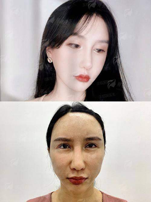 四、柳州华美胡晓波脂肪填充怎么约？保姆级指南