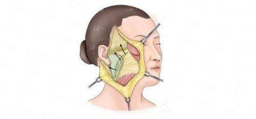 一、北京薇琳医疗美容医院:张晓阳主事的解剖复位技术