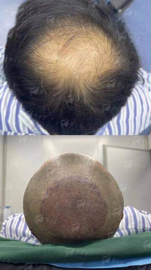 <strong>二、上海艺星医疗美容医院（长宁院）毛发移植技术解析</strong>