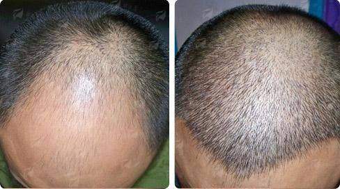 <strong>三、上海艺星医疗美容医院（长宁院）毛发移植手术流程</strong>