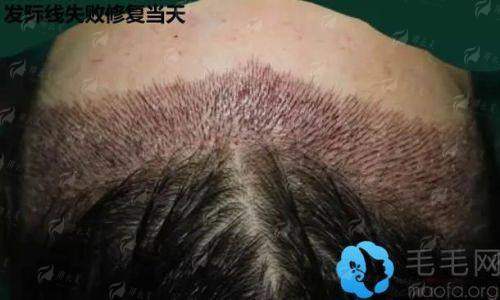 <strong>四、上海艺星医疗美容医院（长宁院）植发失败修复的技术优势</strong>