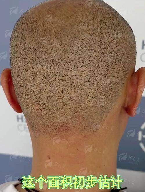 <strong>二、植发失败修复的常见问题及解决方案</strong>