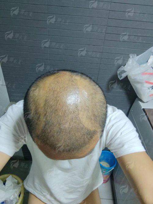 <strong>三、上海艺星医疗美容医院（长宁院）植发失败修复的真实实例</strong>