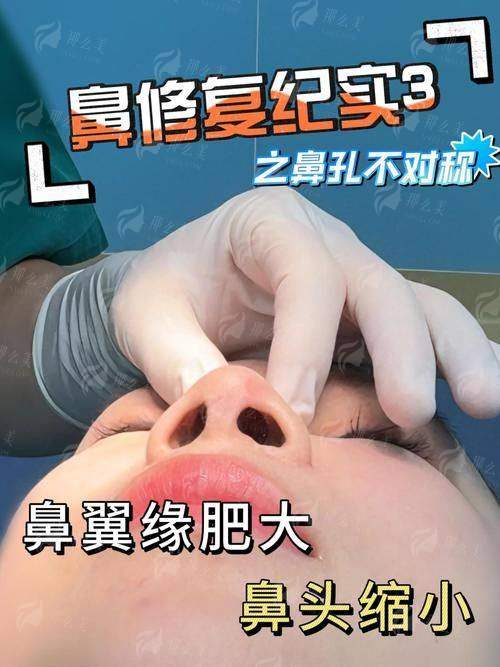 二、呼和浩特亚太周聪院长鼻修复2026价格贵不贵？
