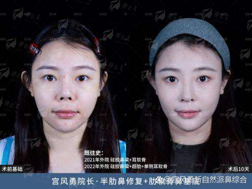 三、成都高新后美鼻修复价格贵吗?性价比分析