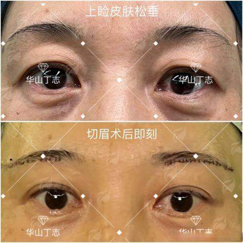 二、河北唐山初见医美的切眉术价格贵吗？