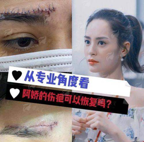 一、河北唐山初见医美的切眉术成效如何？