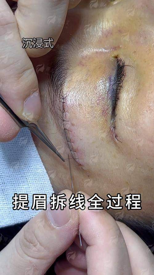 三、河北唐山初见医美的切眉术术后护理怎么做？