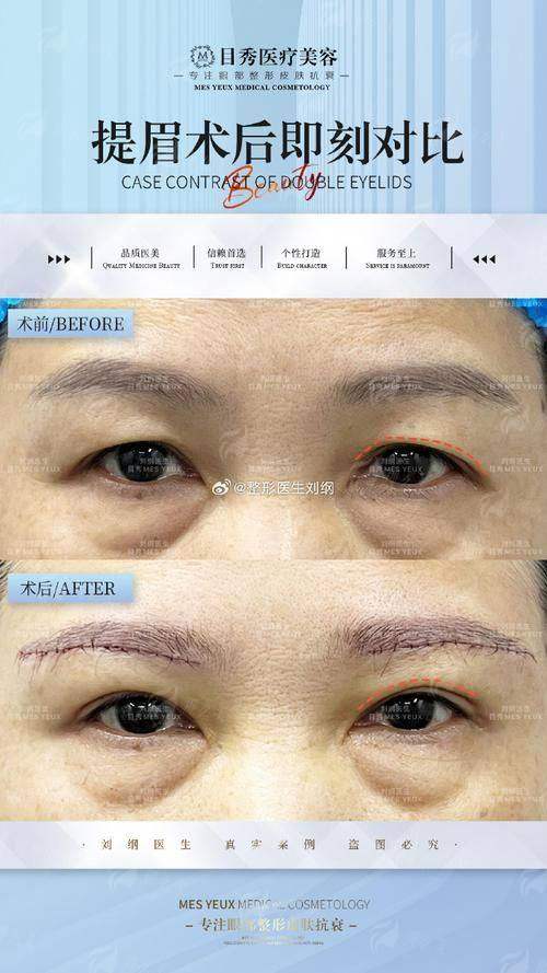 四、河北唐山初见医美的切眉术如何预约？