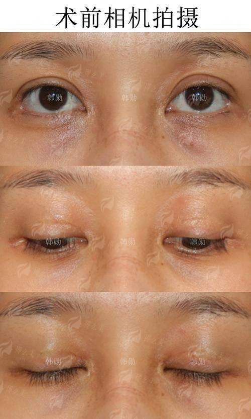 六、如何选择适合自己的双眼皮医生
