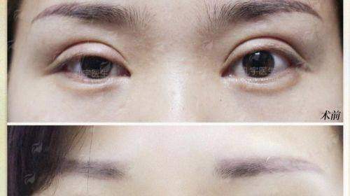 青岛诺德于伟朝和张雪萍双眼皮谁最自然？对比看案例，还有预约挂号方式全公开！