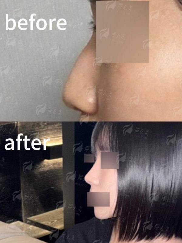 一、哈尔滨超龙医疗美容医院耳骨隆鼻为什么火？姚盛雷医生技术强在哪？