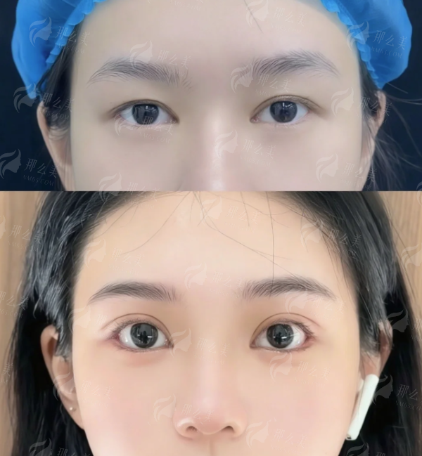 <strong>三、荆州仟之禧陈吉光眼整形价格贵吗？</strong>