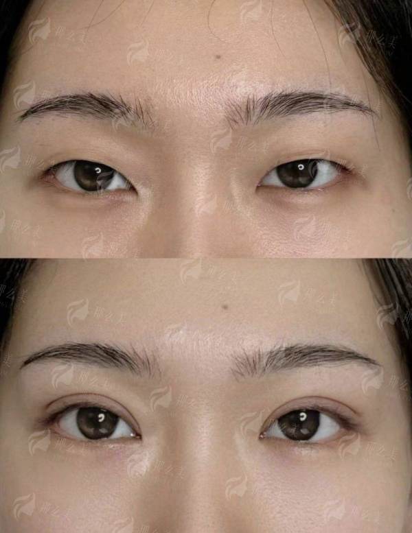 广州曙光阮庆玲医生双眼皮全解析：自然款or网红款？附真人案例+价格对比