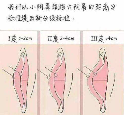 三、广州建国医院处女膜修复有哪些独特优势?