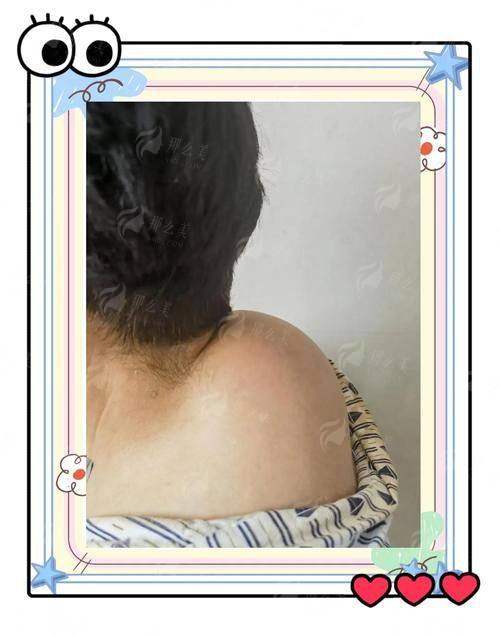 湖南欣姿美医疗美容超微乳化祛富贵包多少钱？价格分析+到院预约指南